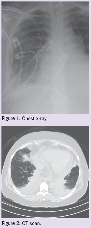 Progressive Dyspnea