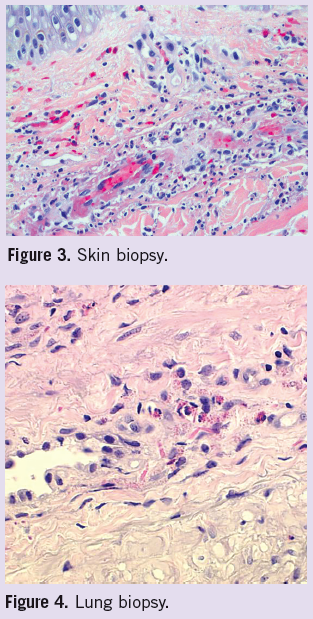 Progressive Dyspnea