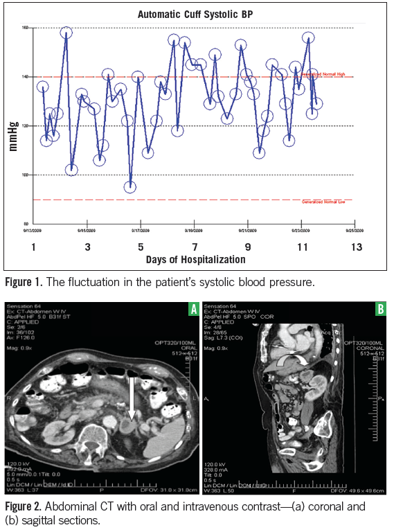 Pheochromocytoma in the Elderly Consultant360