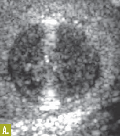 epidermoid cyst
