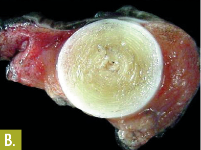 epidermoid cyst