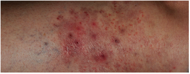 tinea