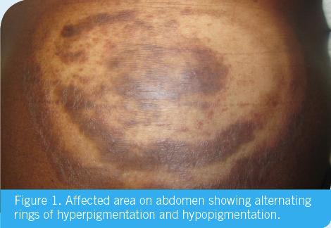 rings of hyperpigmentation