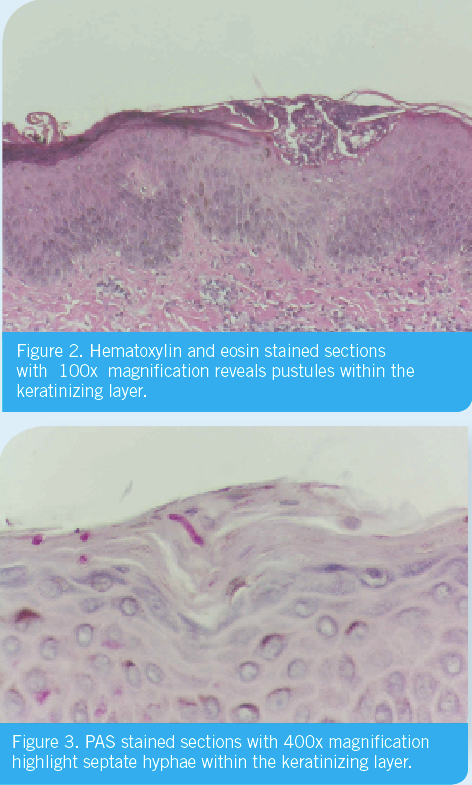 pustules within keratinizing layer
