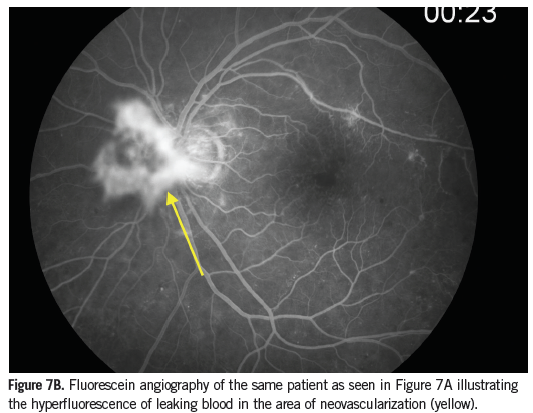 fluorescein angiography
