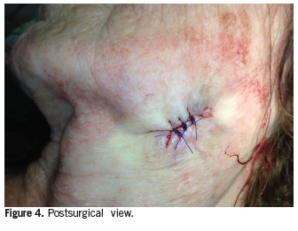 stitches after surgery