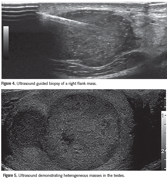 Multiple Cutaneous Nodules