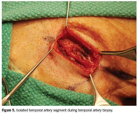 temporal artery biopsy