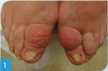 Pretibial myxedema and thyroid acropachy