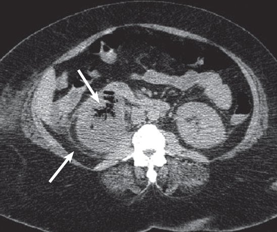 CT scan of the abdomen