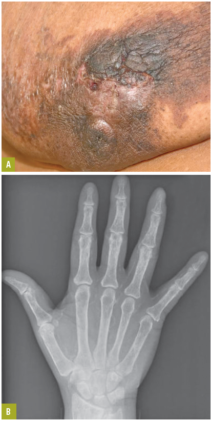 Calciphylaxis