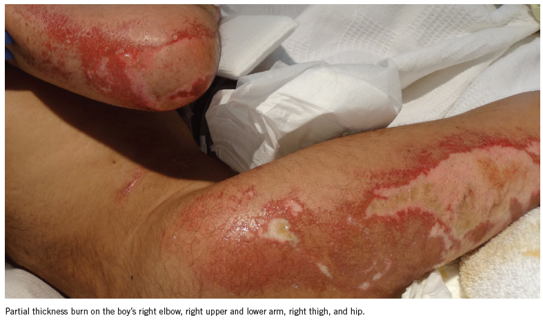 A Boy S Widespread Partial Thickness Burns Are They Inflicted Or Accidental Consultant360 A Boy S Widespread Partial Thickness Burns Are They Inflicted Or Accidental Consultant360