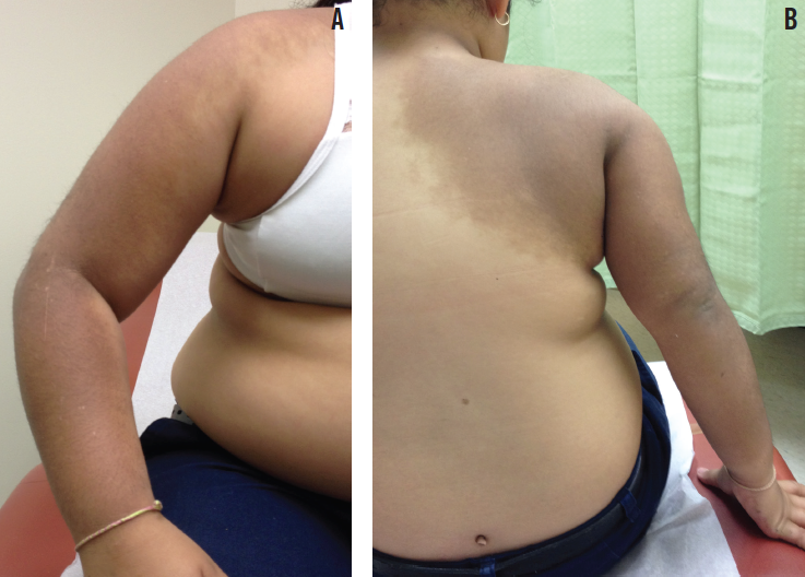 Figures A & B Brown patch