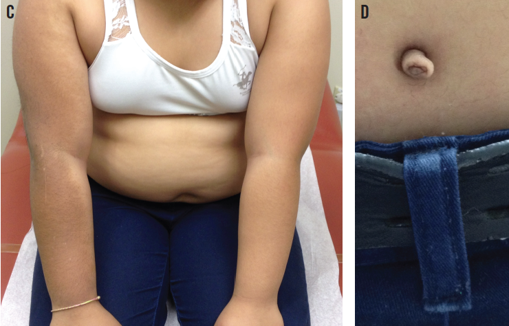 Figures C & D Becker Nevus