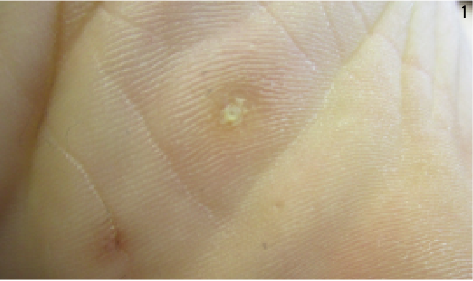 Figure 1 Plantar corn