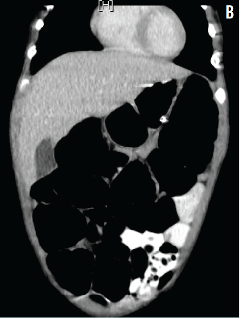 Rotavirus gastroenteritis 