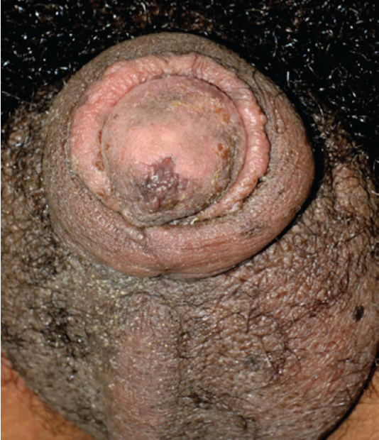 Acute Idiopathic “Lion’s Mane” Scrotal Edema