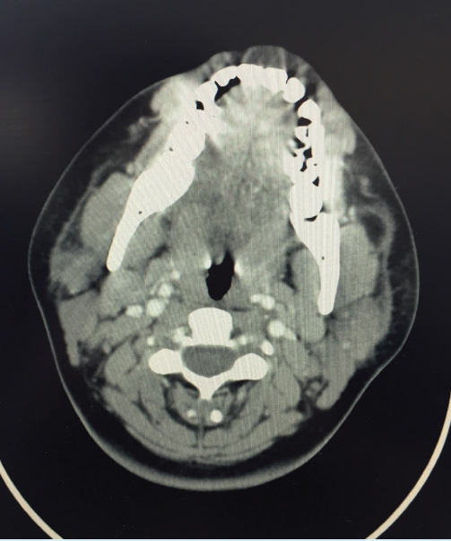 Head/neck CT with contrast showing several enlarged lymph nodes, with the largest on the right cervical region. 