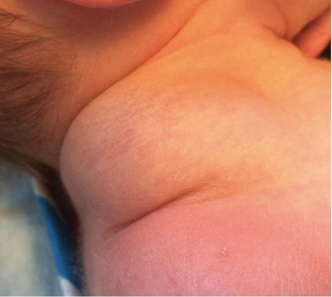 The patient had a soft mass on the right lateral neck.