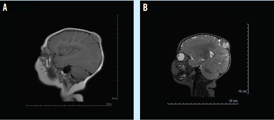 (A) MRI of the brain, sagittal view, T1-weighted image; and (B) sagittal view, T2-weighted image. 