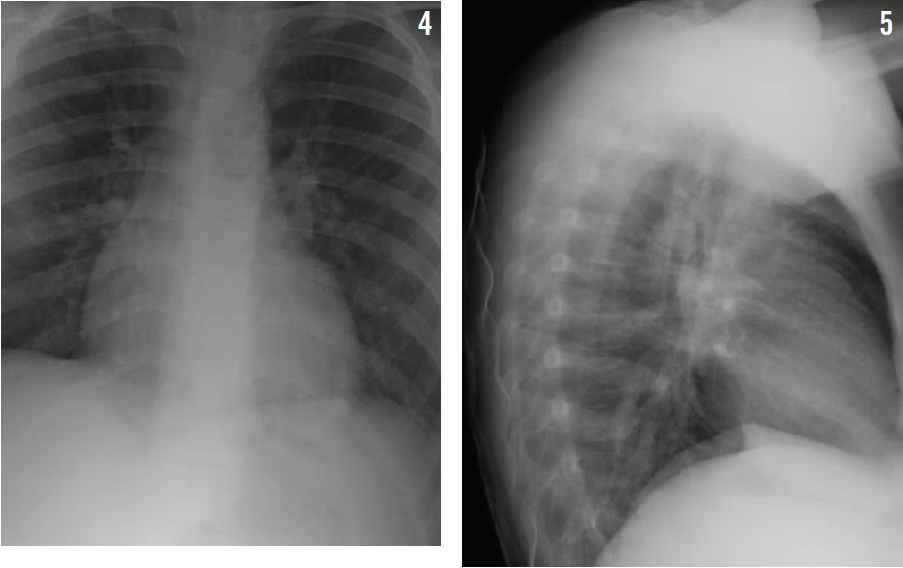 Chest radiographs showed patchy areas of consolidation distributed in both lungs, suggesting bronchopneumonia