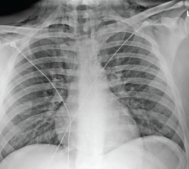 A plain radiograph revealed pneumomediastinum 