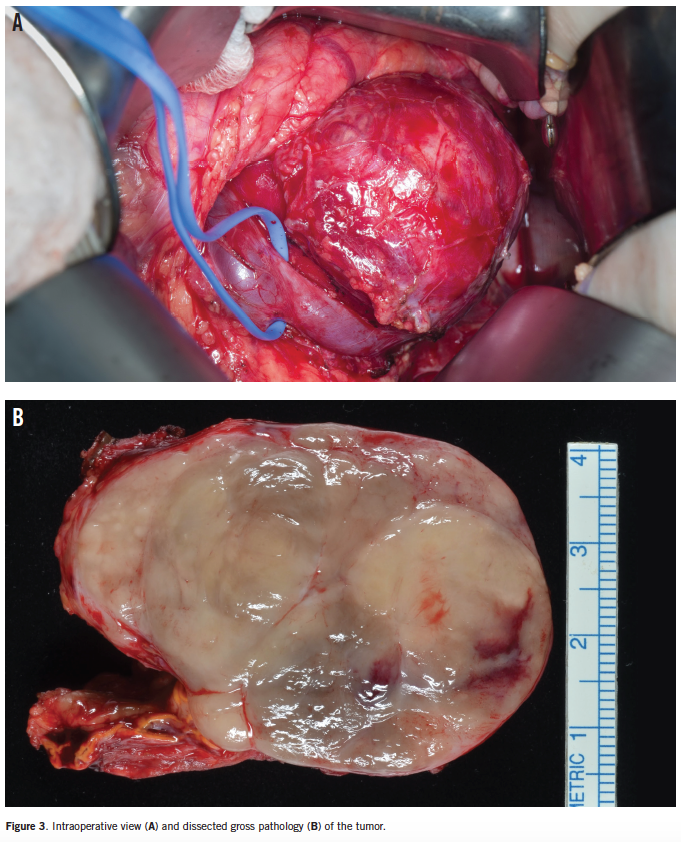 Intraoperative view (A) and dissected gross pathology (B) of the tumor.  