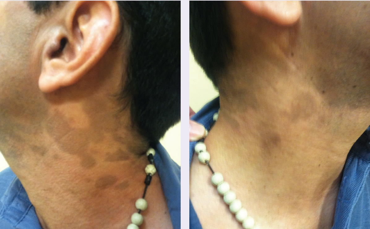Eritema Discromico Perstans Dermatosis Cenicienta En Edad Pedi trica Eritema Discromico Perstans Dermatosis Cenicienta En Edad Pedi trica