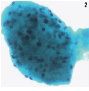Pneumocystis jiroveci cysts