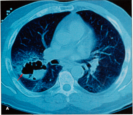 lung cancer