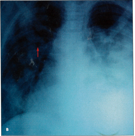 lung cancer