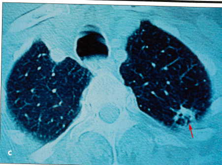lung cancer