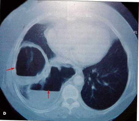 lung cancer
