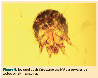 sarcoptes scabiei