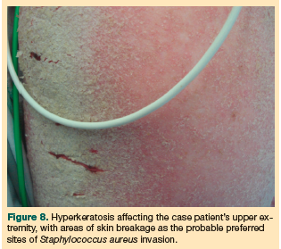 hyperkeratosis upper extremity