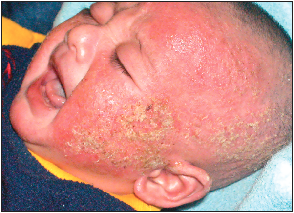 atopic dermatitis