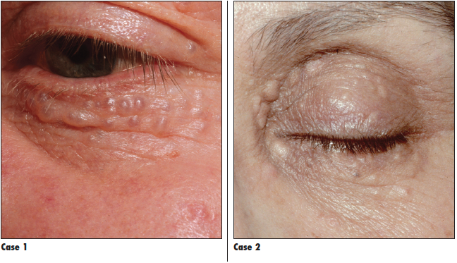 dermatologic eye issues