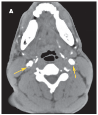 carotid dissection