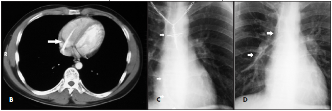 ewing sarcoma 