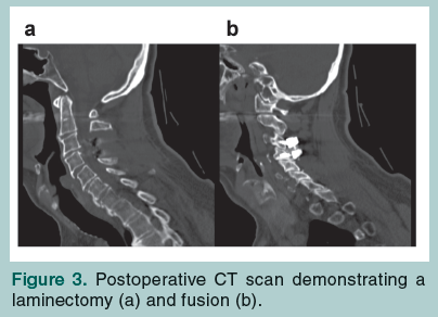 laminectomy and fusion