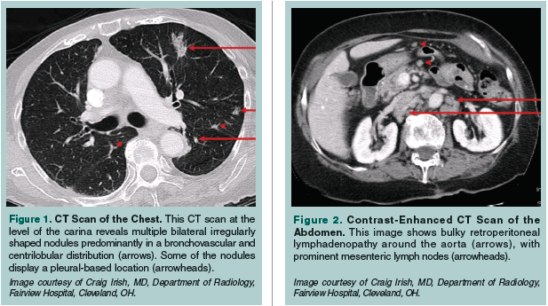 CT scan of the chest and abdomen