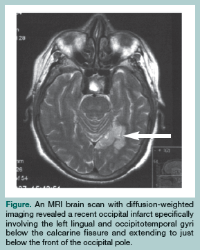 MRI brain scan