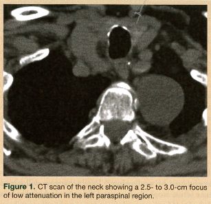 CT scan of neck