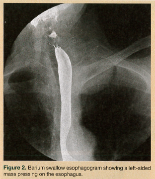 mass pressin gon esophagus