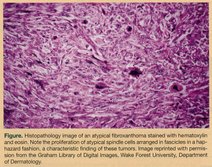 atypical fibroxanthoma
