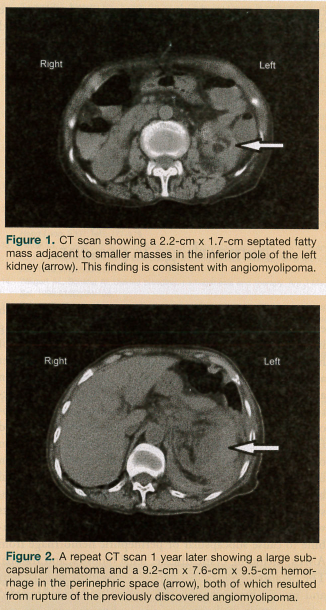 CT Scans