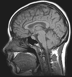 Heart Failure Associated With Loss Of Gray Matter | Consultant360
