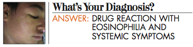 drug reaction with eosinophilia