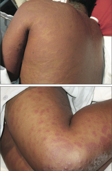 drug reaction back and leg