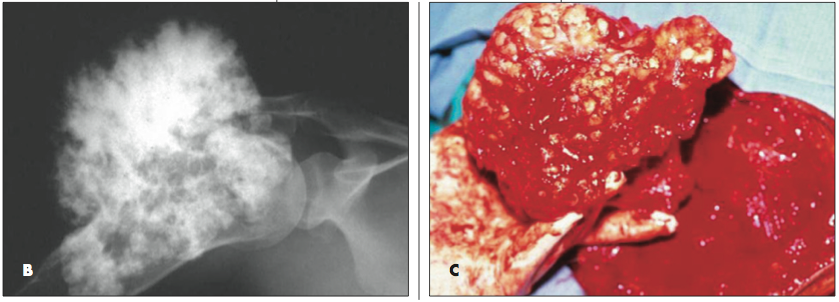 Chondrosarcoma